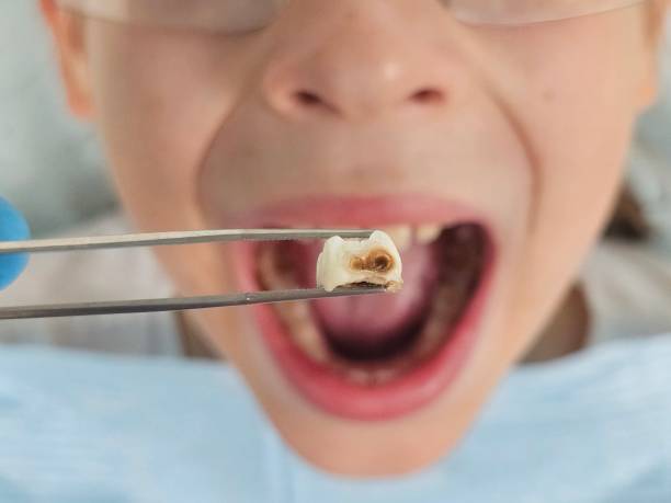 Best Broken or Chipped Tooth Repair in Universal City, TX